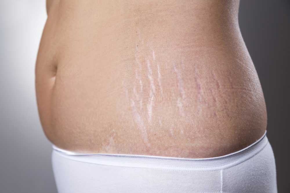 Stretch-Marks