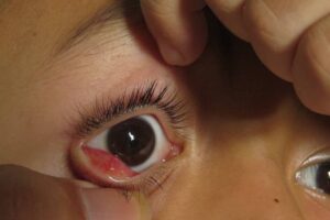 Conjunctivochalasis: A Cause for Dry Eyes and How to Solve It
