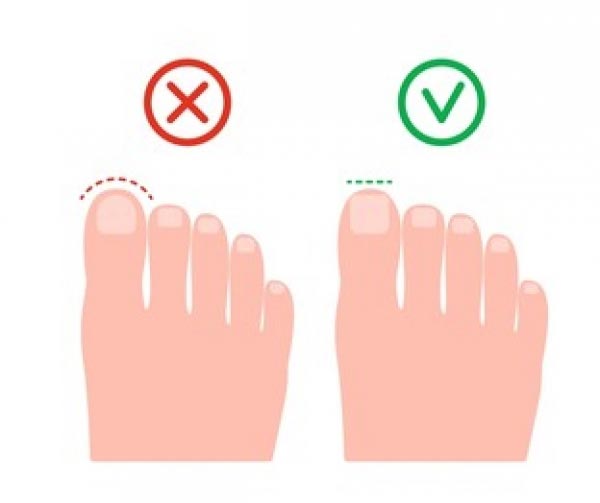 How To Get Toenails To Grow Straight