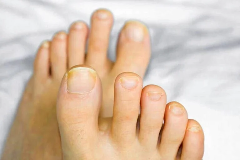 best-socks-for-ingrown-toenails
