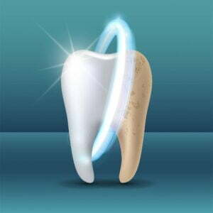 Does Teeth Whitening Damage Enamel?