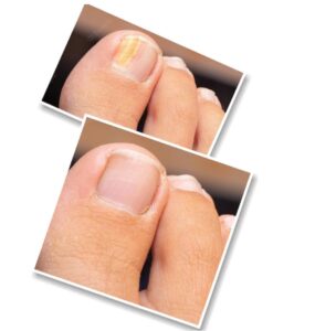 How To Get Rid Of Ugly Toenails: A Step-By-Step Guide