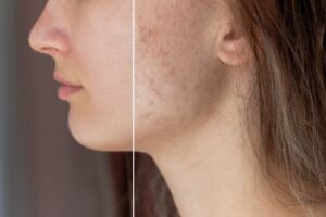 Treatment for Your Acne Scarring