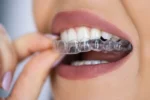 The Rise of Clear Aligners